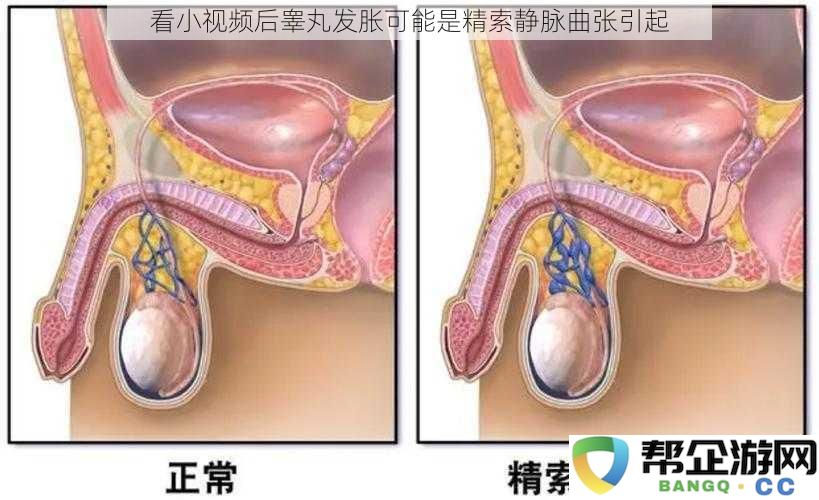 看小视频后睾丸发胀可能是精索静脉曲张引起